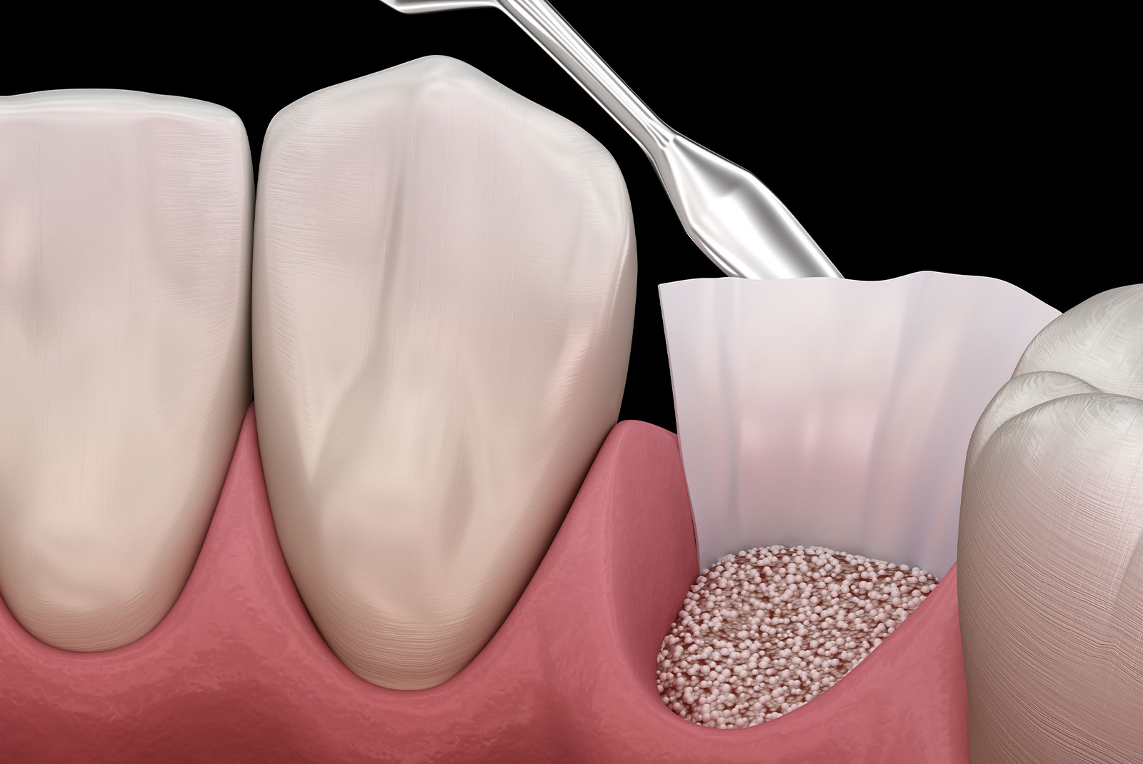 bone grafting procedure socket preservation