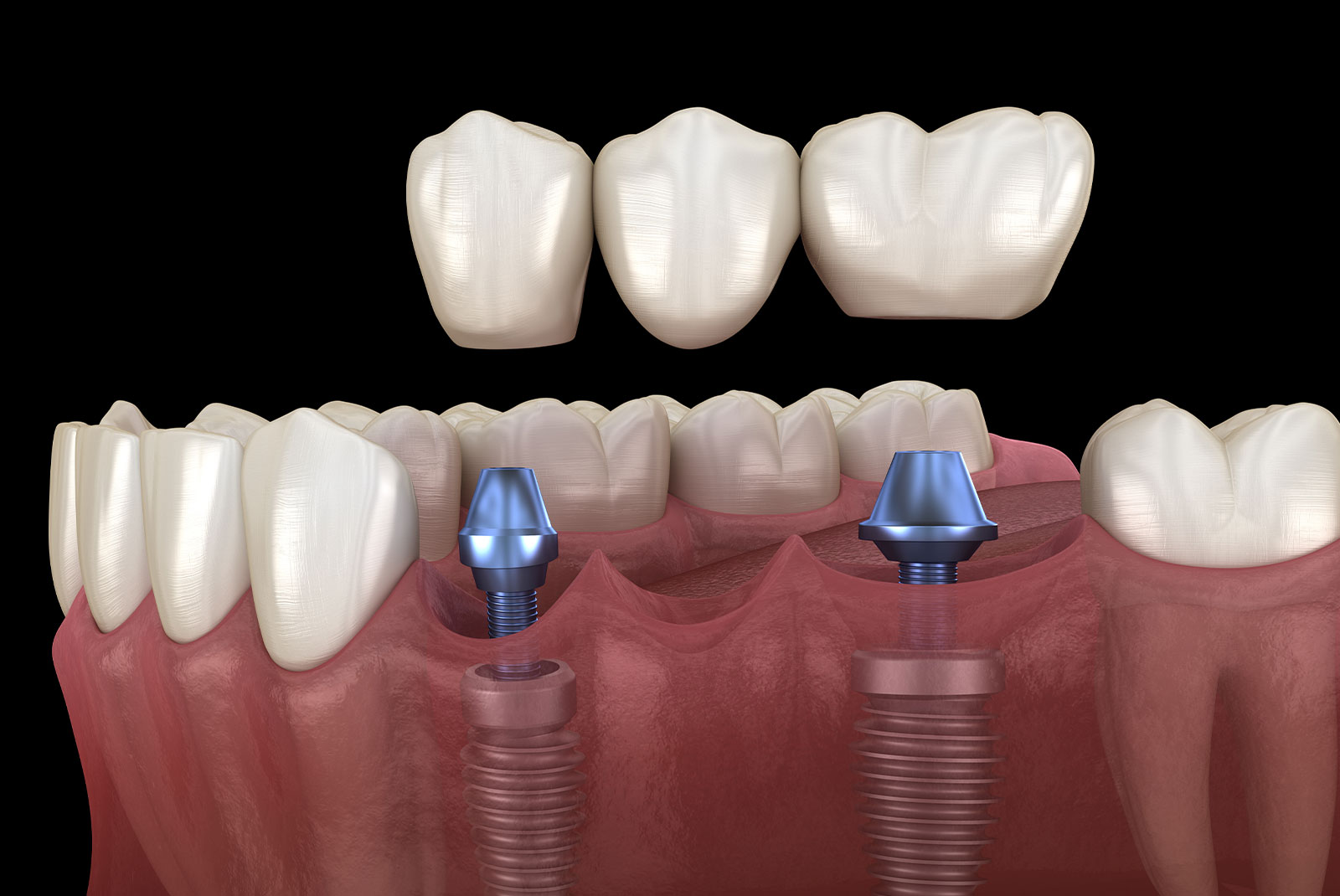 dental bridge 3d 5050