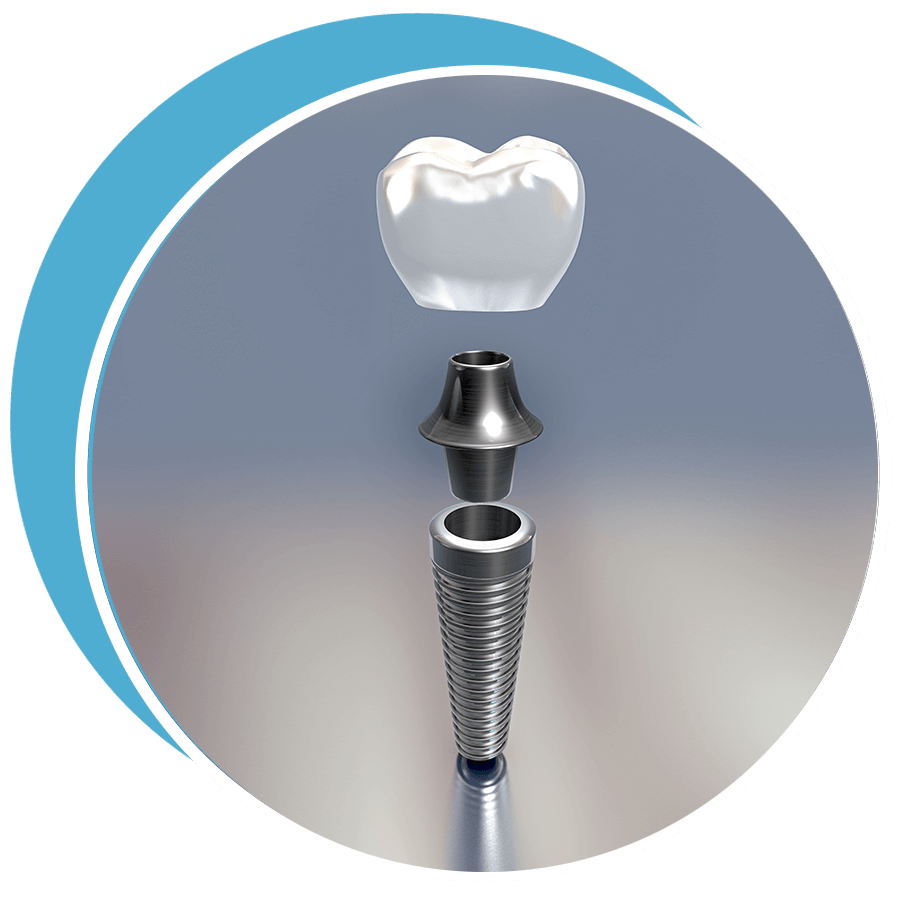 dental implant 3d