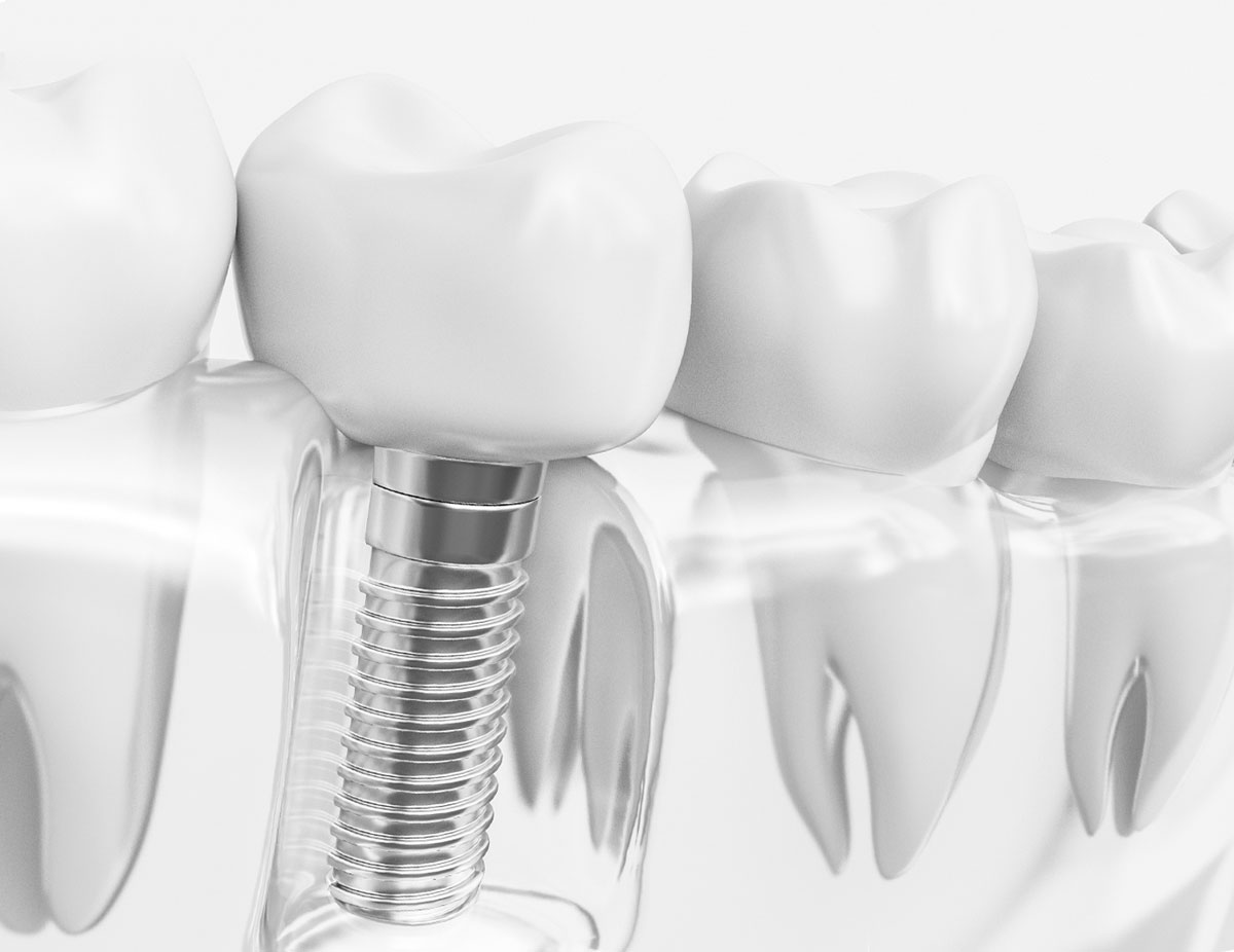 single dental implants white