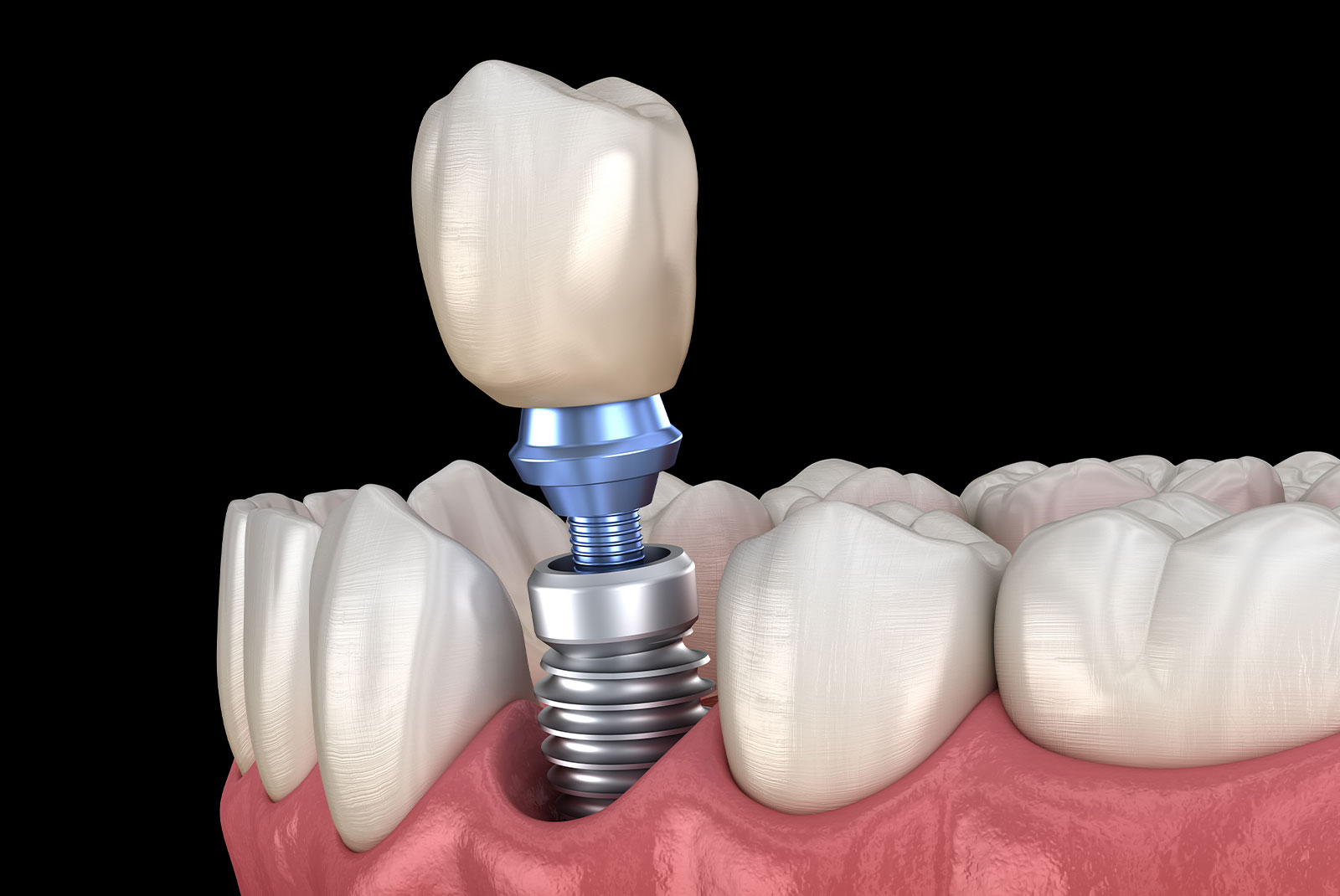 dental implant 3d new 5050