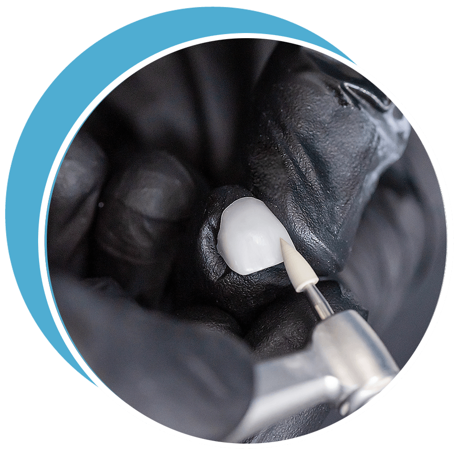 hand crafted dental veneer