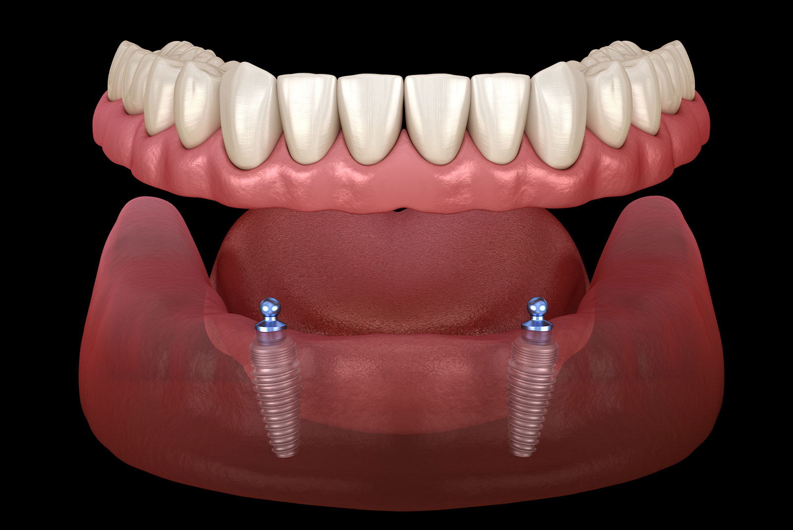 implant supported denture 3d 5050