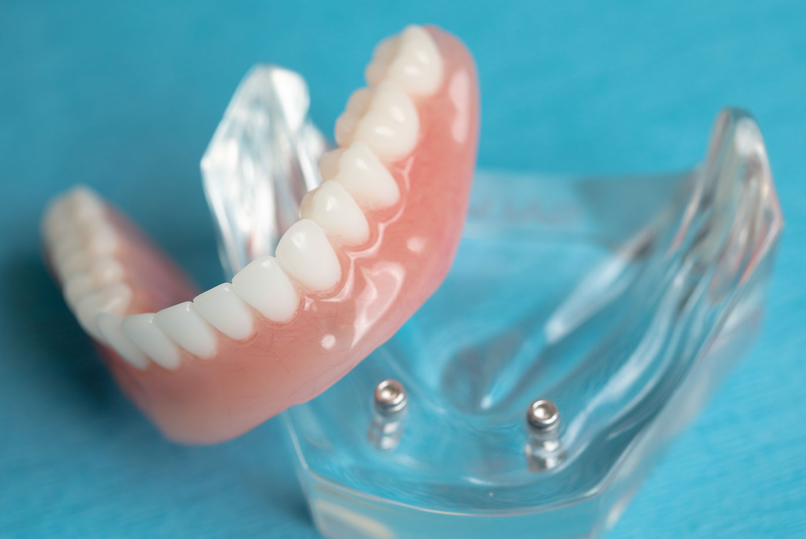 implant supported denture real 5050