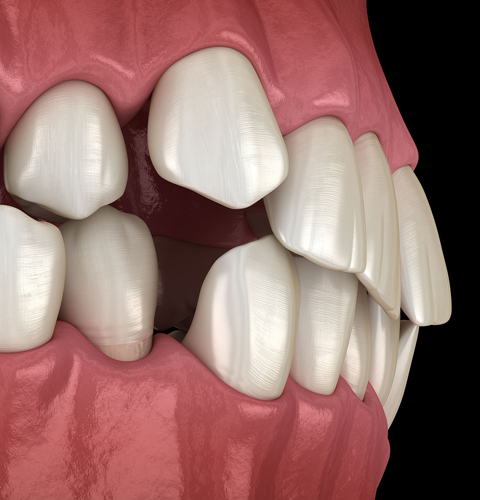 mis aligned jaw 3d
