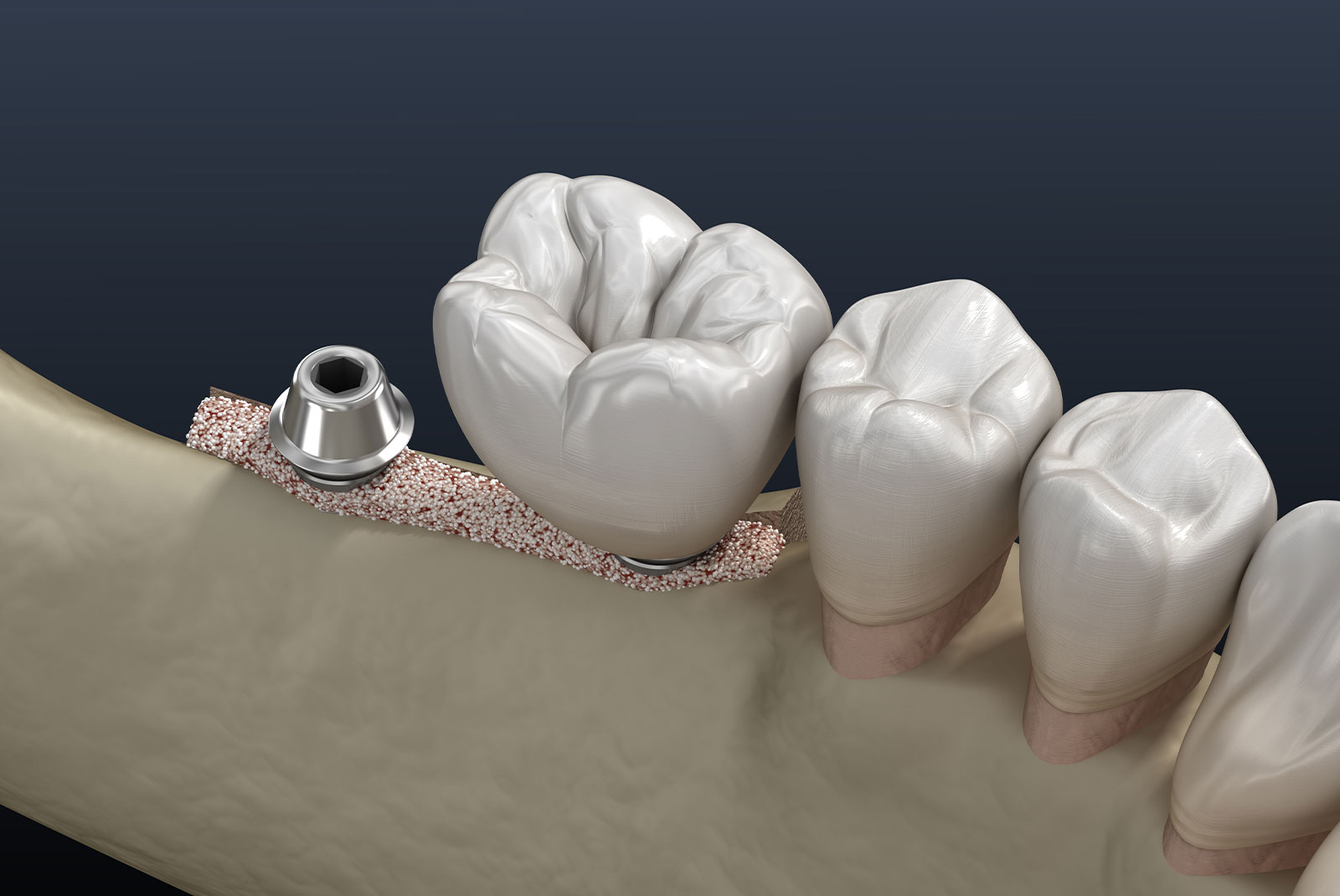 ridge augmentation bone graft