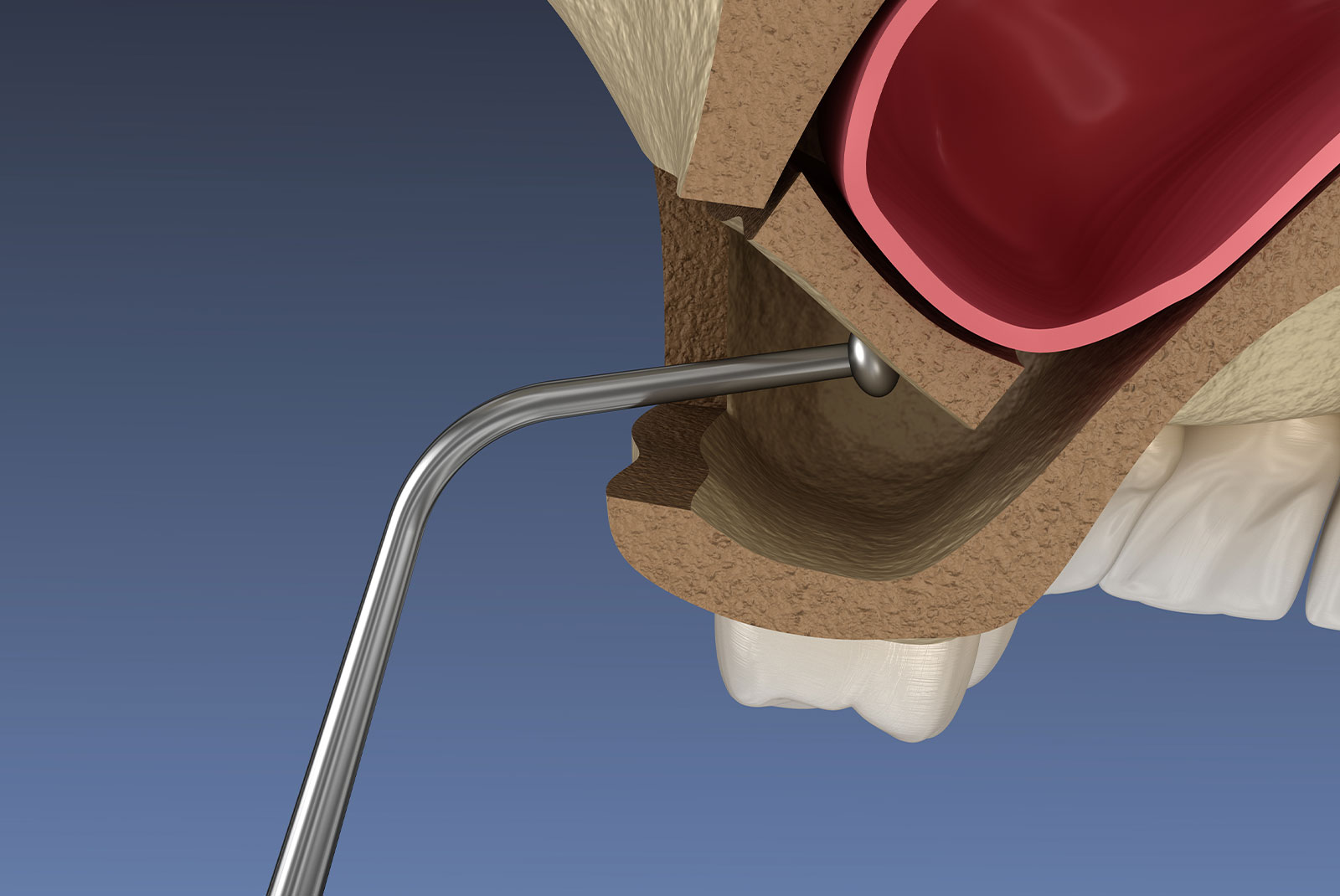 sinus lift 3d bone graft