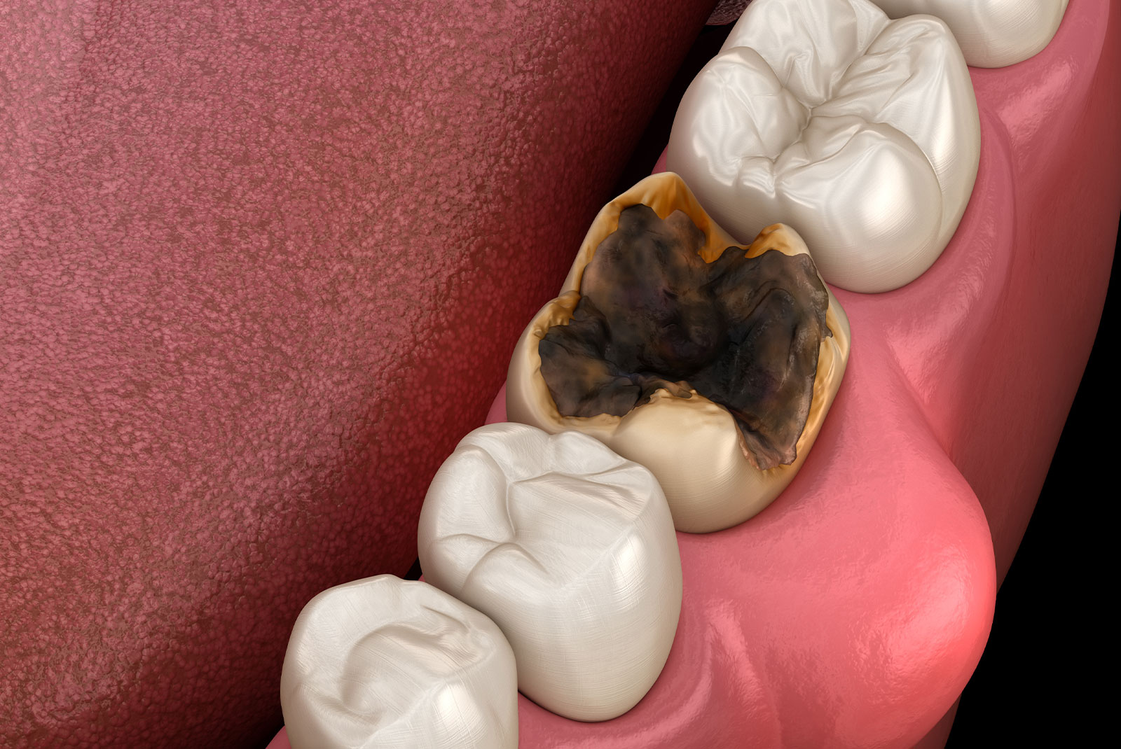 tooth decay needing extracted