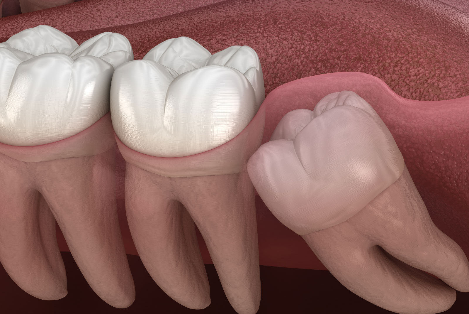 wisdom tooth rupturing