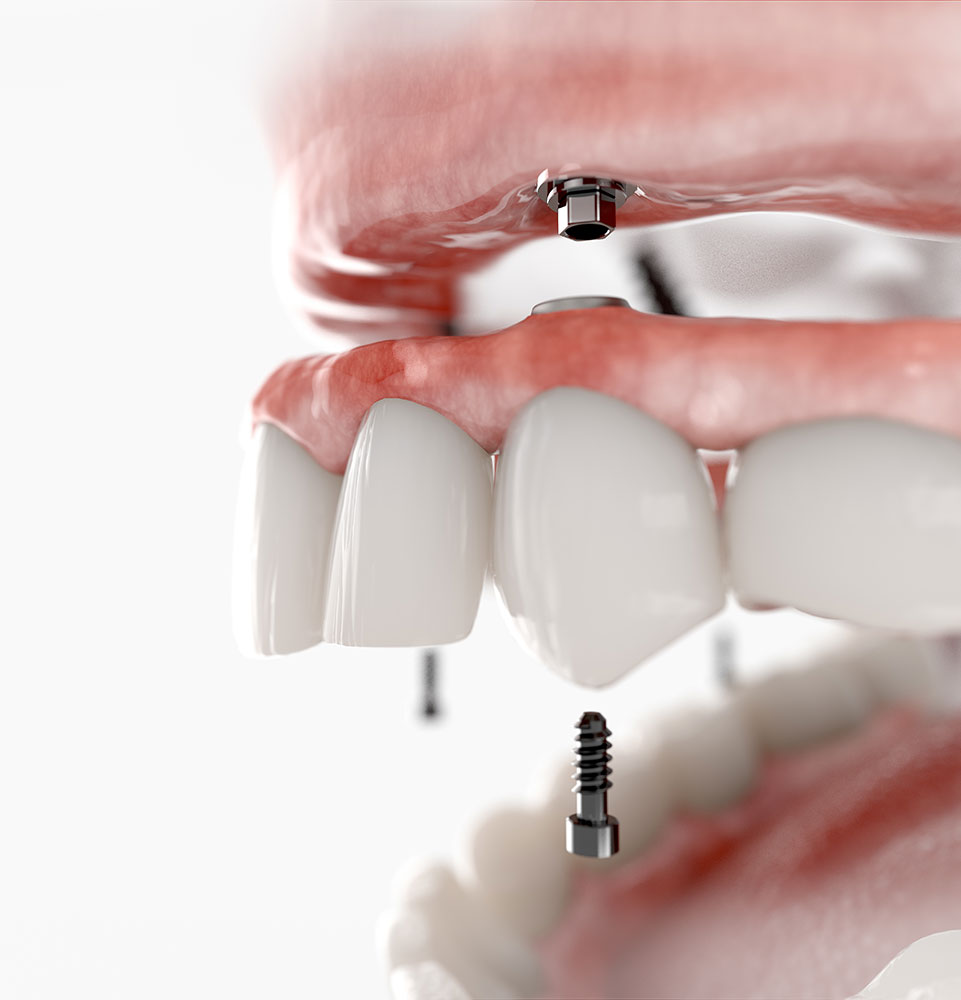 Dental implant
