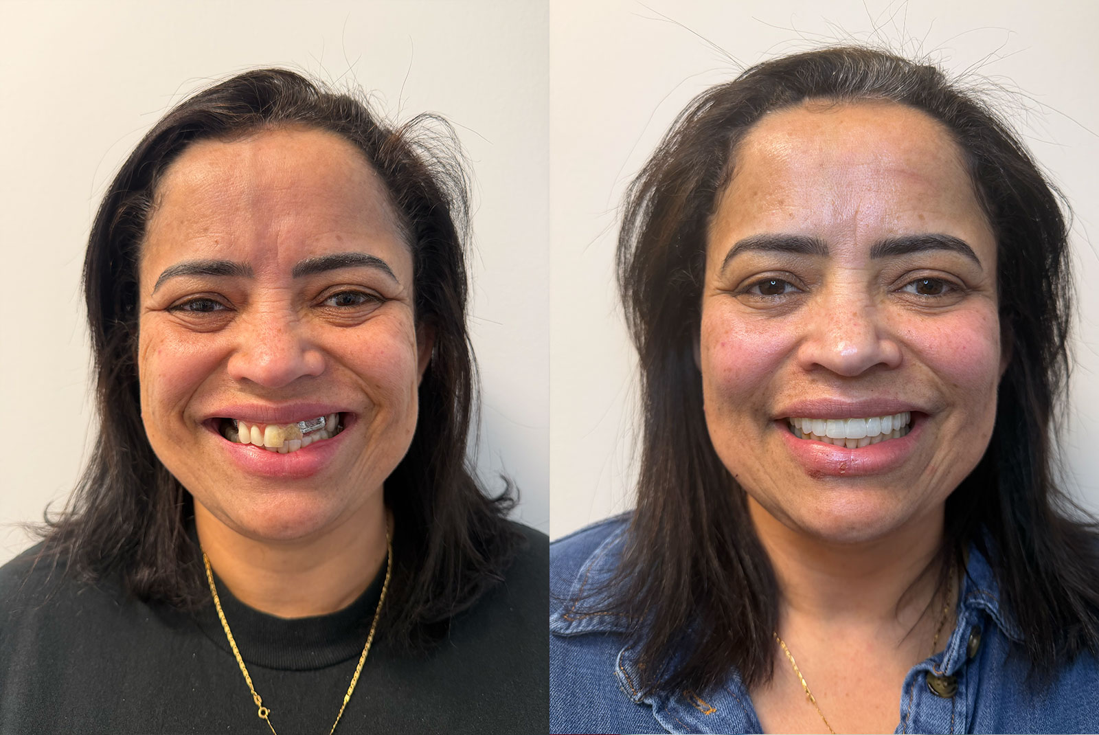 BA full arch dental implants 1