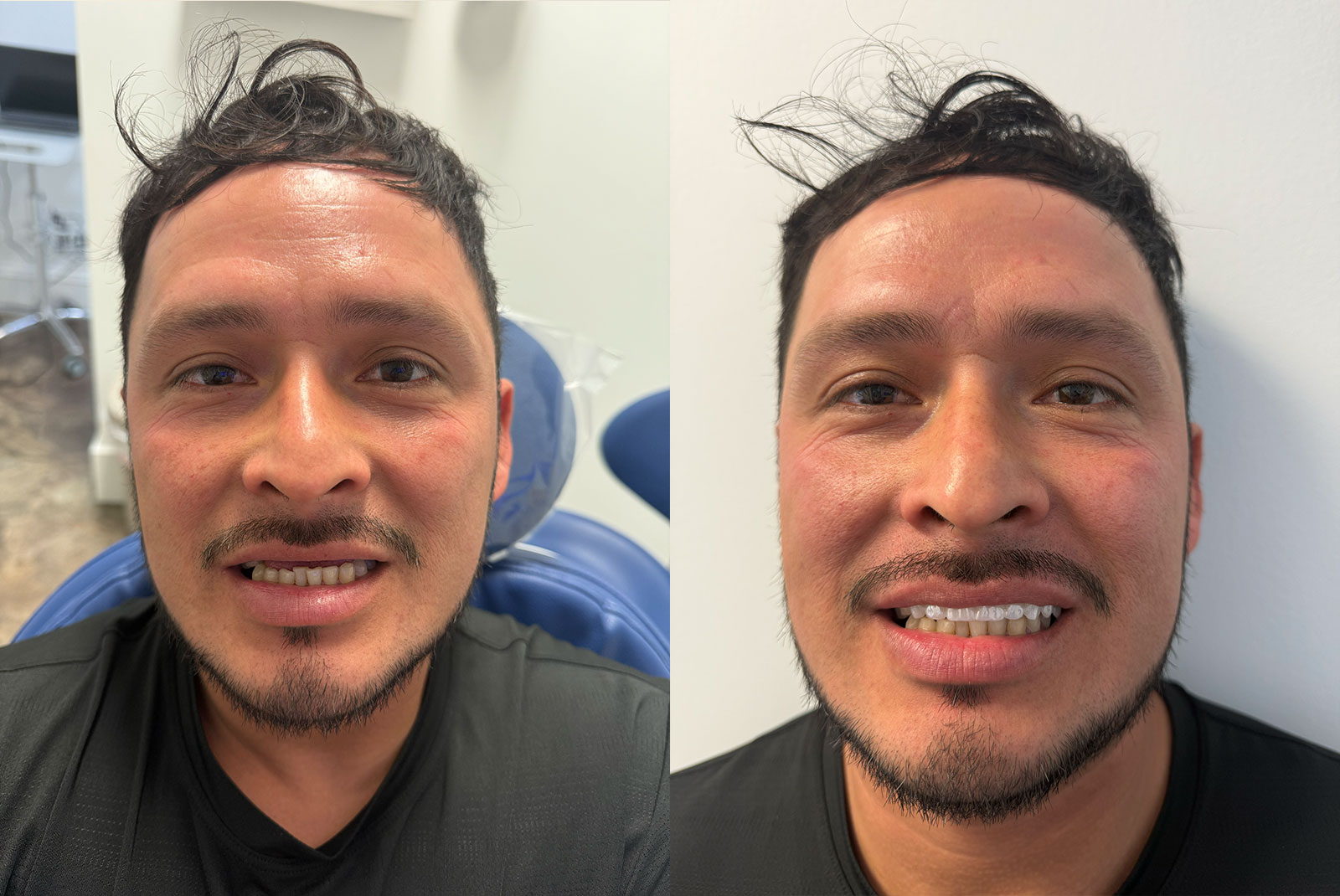 BA full arch dental implants 2