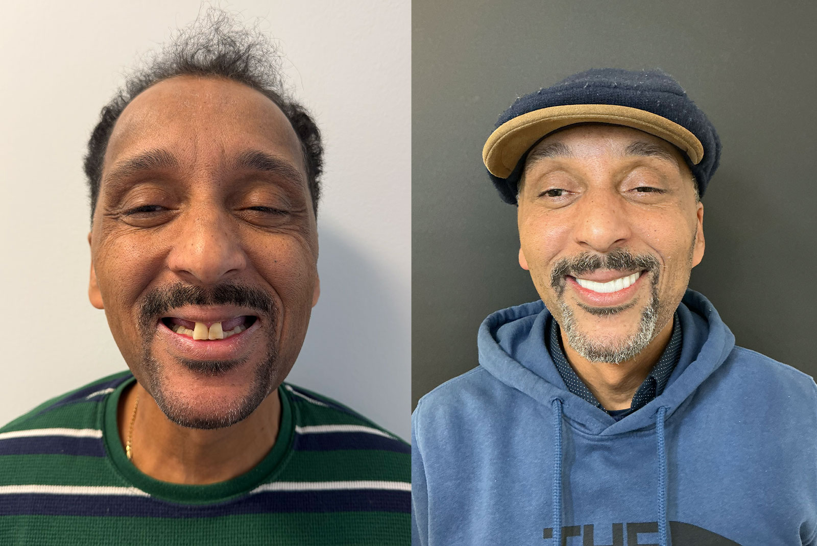 BA full arch dental implants 3